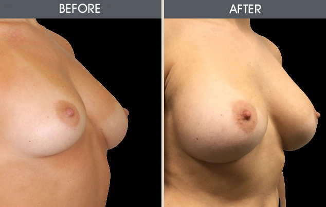 Real patient results in New York, NY Performed by Darrick E. Antell MD, FACS