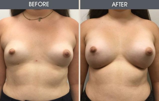 Real patient results in New York, NY Performed by Darrick E. Antell MD, FACS