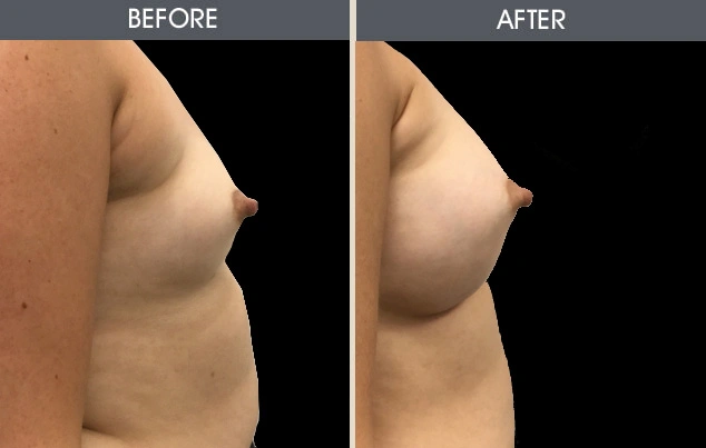 Real patient results in New York, NY Performed by Darrick E. Antell MD, FACS