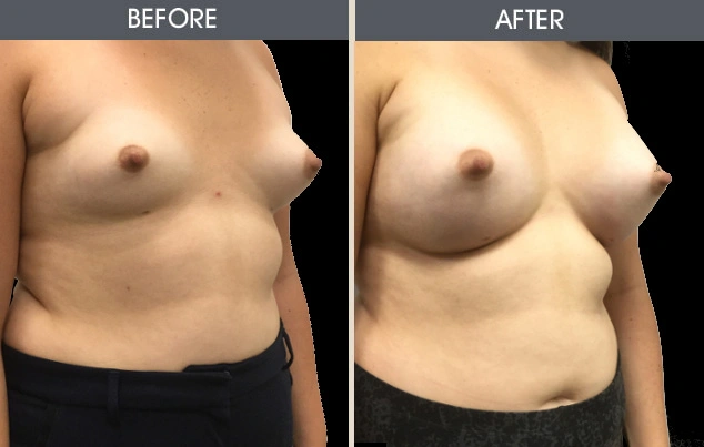 Real patient results in New York, NY Performed by Darrick E. Antell MD, FACS