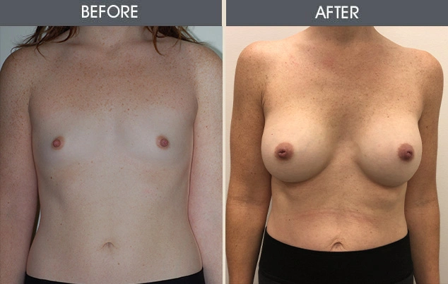 Real patient results in New York, NY Performed by Darrick E. Antell MD, FACS