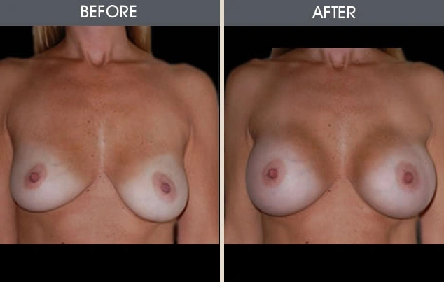 Real patient results in New York, NY Performed by Darrick E. Antell MD, FACS
