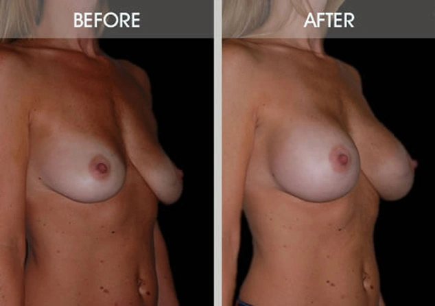 Real patient results in New York, NY Performed by Darrick E. Antell MD, FACS