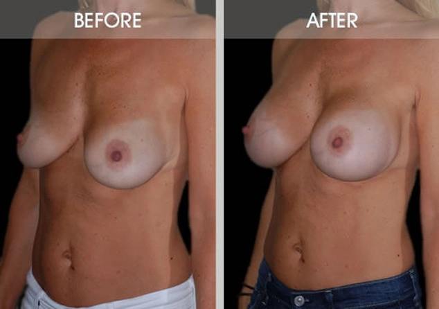 Real patient results in New York, NY Performed by Darrick E. Antell MD, FACS