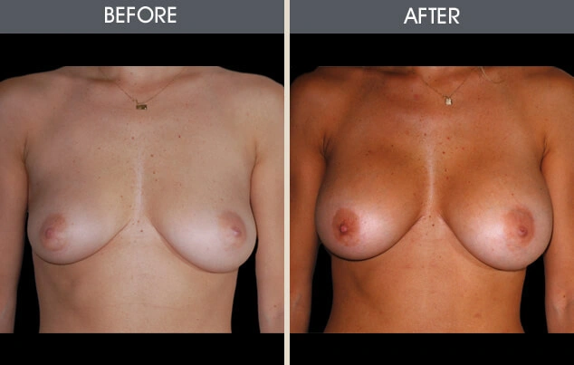Real patient results in New York, NY Performed by Darrick E. Antell MD, FACS