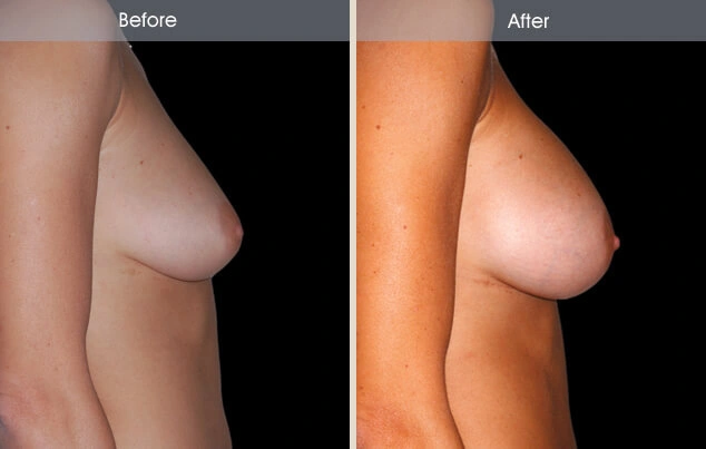 Real patient results in New York, NY Performed by Darrick E. Antell MD, FACS