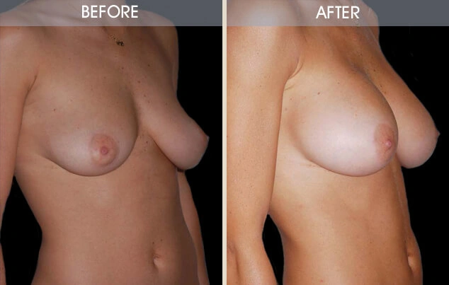 Real patient results in New York, NY Performed by Darrick E. Antell MD, FACS