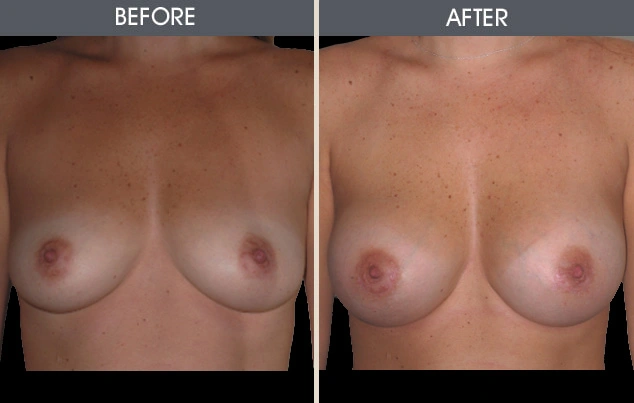 Real patient results in New York, NY Performed by Darrick E. Antell MD, FACS
