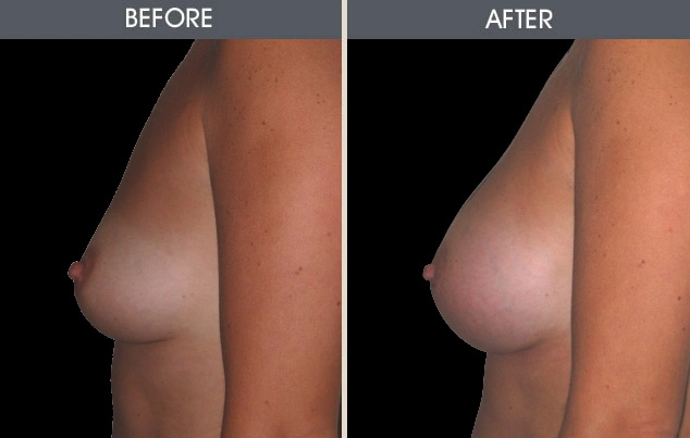 Real patient results in New York, NY Performed by Darrick E. Antell MD, FACS