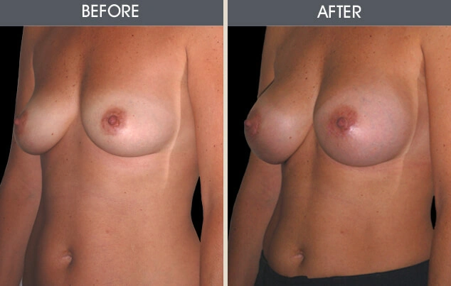 Real patient results in New York, NY Performed by Darrick E. Antell MD, FACS