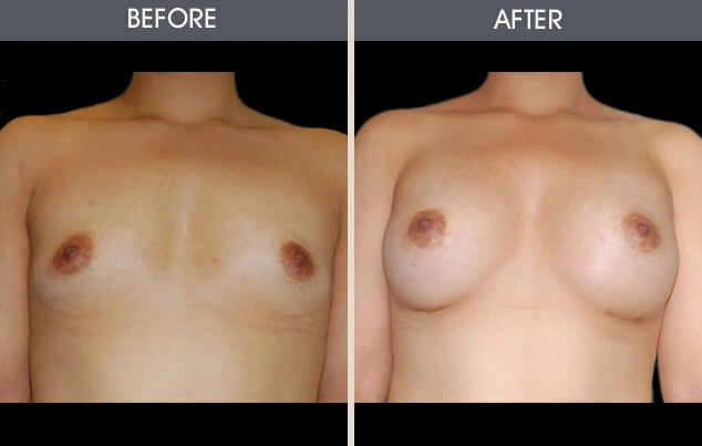 Real patient results in New York, NY Performed by Darrick E. Antell MD, FACS