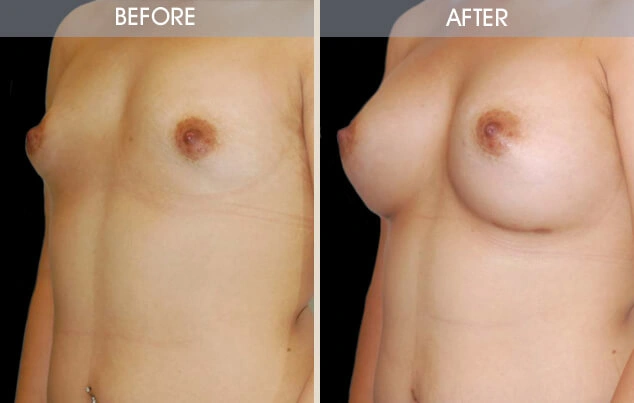Real patient results in New York, NY Performed by Darrick E. Antell MD, FACS