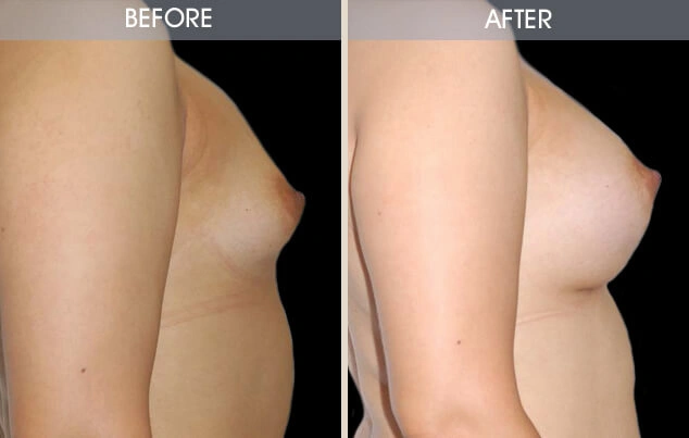 Real patient results in New York, NY Performed by Darrick E. Antell MD, FACS