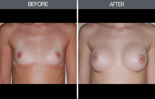 Real patient results in New York, NY Performed by Darrick E. Antell MD, FACS