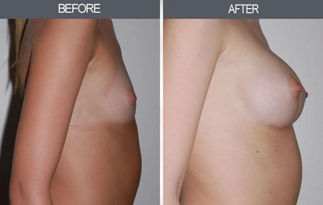 Real patient results in New York, NY Performed by Darrick E. Antell MD, FACS