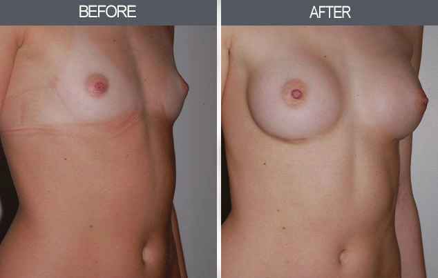 Real patient results in New York, NY Performed by Darrick E. Antell MD, FACS