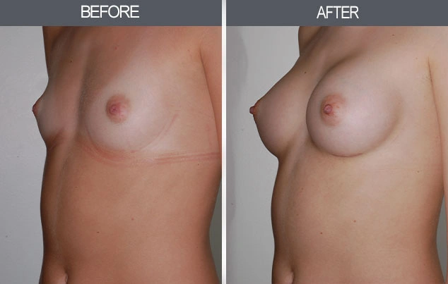 Real patient results in New York, NY Performed by Darrick E. Antell MD, FACS