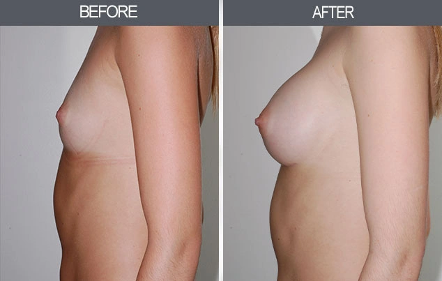 Real patient results in New York, NY Performed by Darrick E. Antell MD, FACS