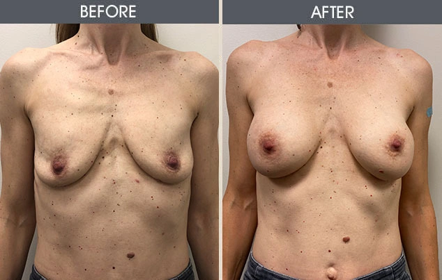 Real patient results in New York, NY Performed by Darrick E. Antell MD, FACS