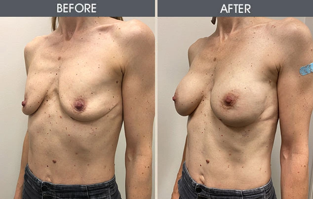 Real patient results in New York, NY Performed by Darrick E. Antell MD, FACS
