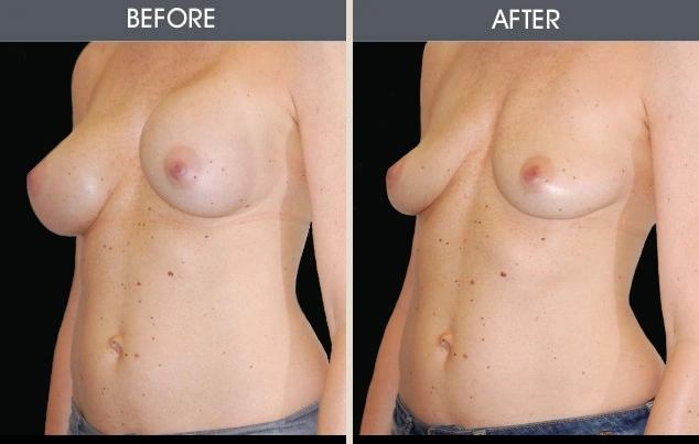 Real patient results in New York, NY Performed by Darrick E. Antell MD, FACS