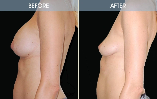 Real patient results in New York, NY Performed by Darrick E. Antell MD, FACS