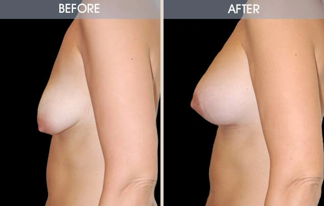 Real patient results in New York, NY Performed by Darrick E. Antell MD, FACS