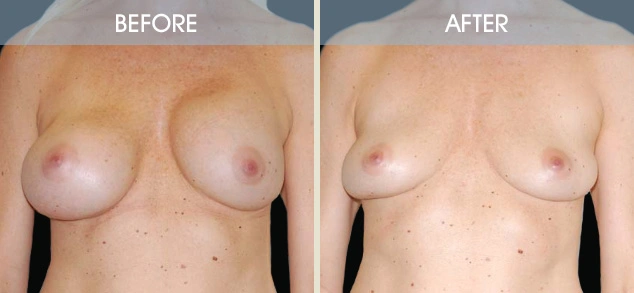 Real patient results in New York, NY Performed by Darrick E. Antell MD, FACS