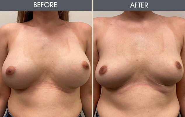 Real patient results in New York, NY Performed by Darrick E. Antell MD, FACS