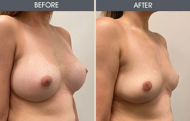 Real patient results in New York, NY Performed by Darrick E. Antell MD, FACS