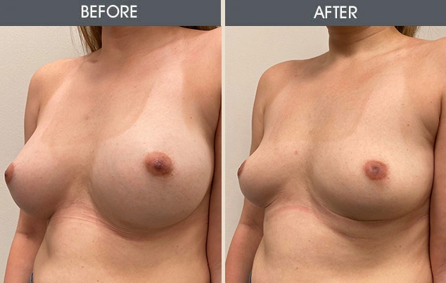 Real patient results in New York, NY Performed by Darrick E. Antell MD, FACS