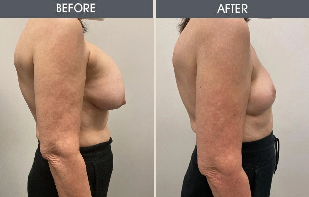 Real patient results in New York, NY Performed by Darrick E. Antell MD, FACS