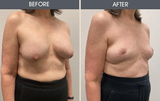 Real patient results in New York, NY Performed by Darrick E. Antell MD, FACS