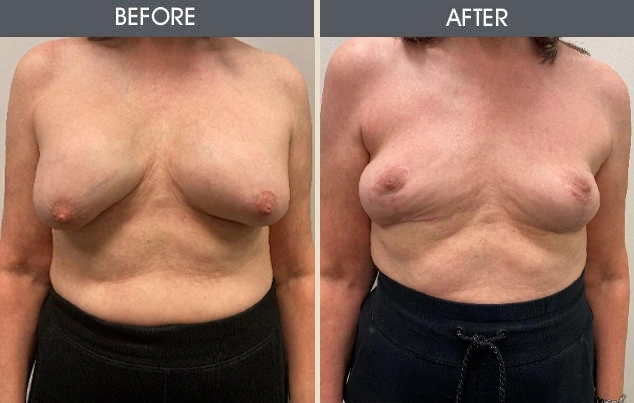 Real patient results in New York, NY Performed by Darrick E. Antell MD, FACS