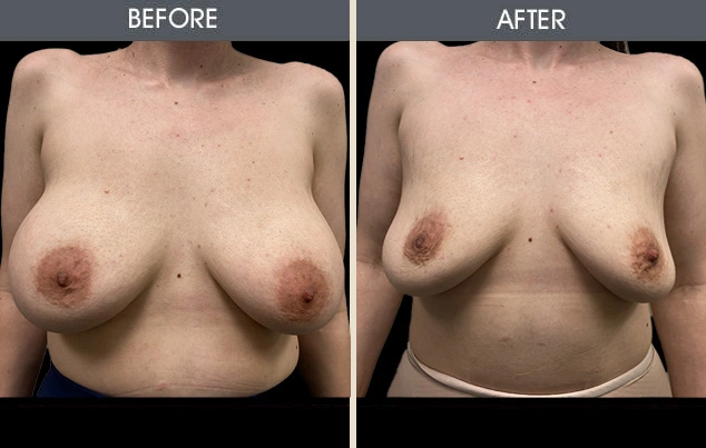 Real patient results in New York, NY Performed by Darrick E. Antell MD, FACS