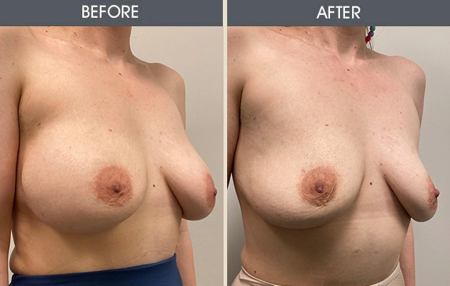 Real patient results in New York, NY Performed by Darrick E. Antell MD, FACS