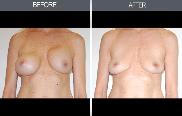 Real patient results in New York, NY Performed by Darrick E. Antell MD, FACS