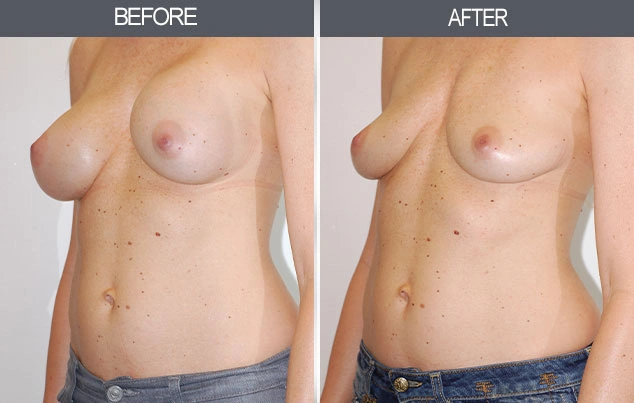 Real patient results in New York, NY Performed by Darrick E. Antell MD, FACS
