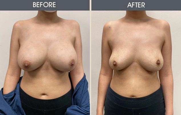 Real patient results in New York, NY Performed by Darrick E. Antell MD, FACS