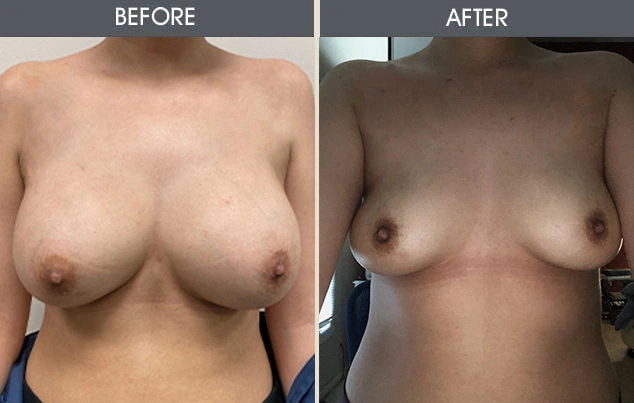 Real patient results in New York, NY Performed by Darrick E. Antell MD, FACS