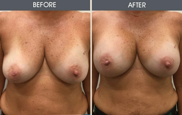 Real patient results in New York, NY Performed by Darrick E. Antell MD, FACS