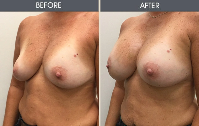 Real patient results in New York, NY Performed by Darrick E. Antell MD, FACS