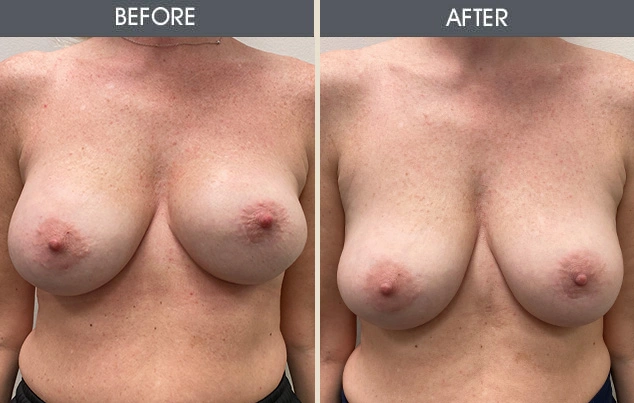 Real patient results in New York, NY Performed by Darrick E. Antell MD, FACS