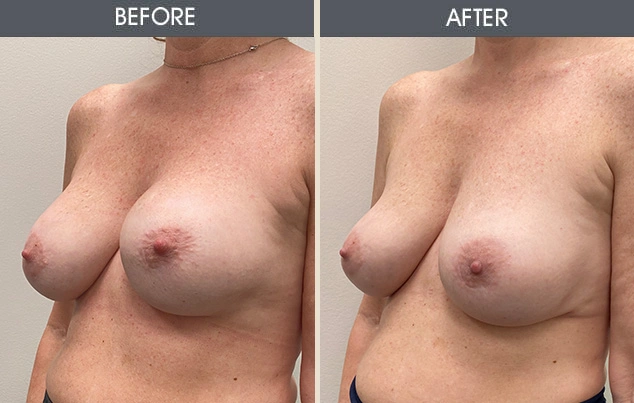 Real patient results in New York, NY Performed by Darrick E. Antell MD, FACS