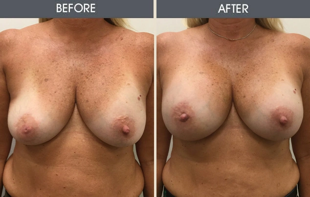 Real patient results in New York, NY Performed by Darrick E. Antell MD, FACS