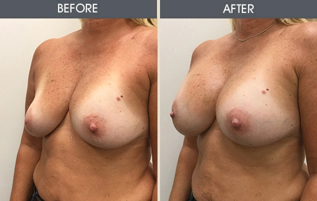Real patient results in New York, NY Performed by Darrick E. Antell MD, FACS