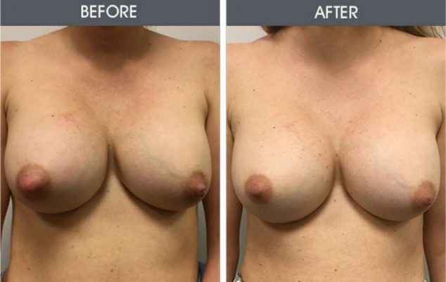 Real patient results in New York, NY Performed by Darrick E. Antell MD, FACS
