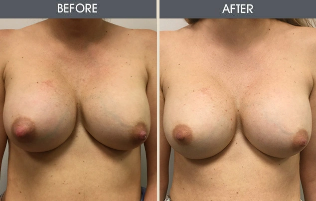 Real patient results in New York, NY Performed by Darrick E. Antell MD, FACS