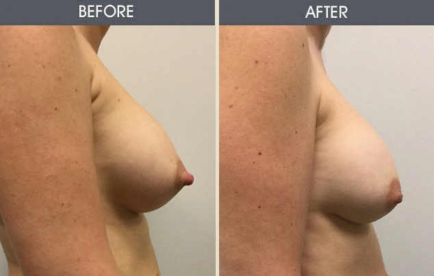 Real patient results in New York, NY Performed by Darrick E. Antell MD, FACS