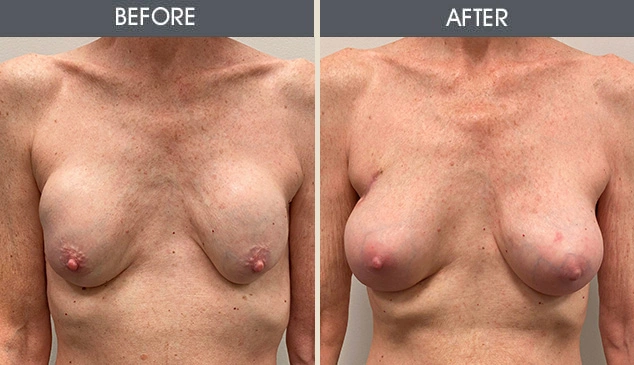 Real patient results in New York, NY Performed by Darrick E. Antell MD, FACS